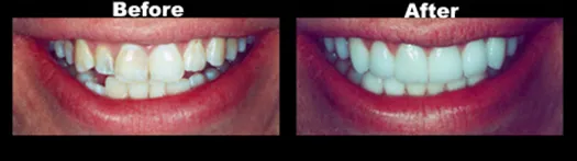 Smile Transformation — Case 10