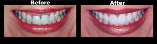 Smile Transformation — Case 2