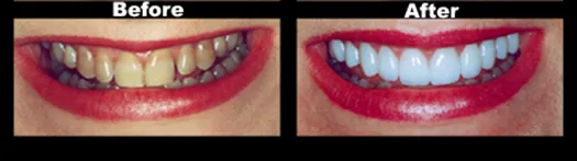 Smile Transformation — Case 3