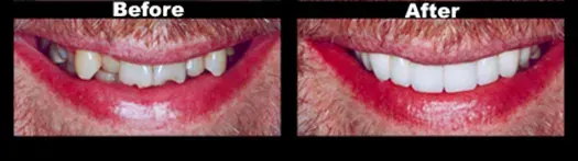 Smile Transformation — Case 7
